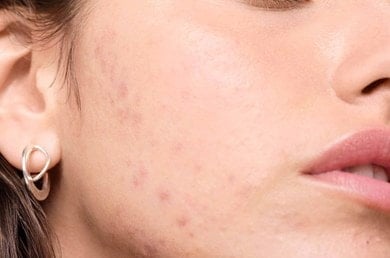 Nahaufnahme einer Person mit sichtbarer Akne auf der Wange zur Darstellung von Hautunreinheiten