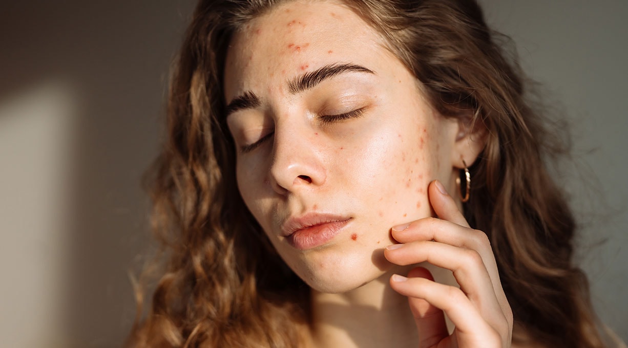 Eine junge Frau mit braunen Locken und Aknemalen steht mit geschlossenen Augen in der Sonne 