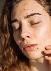 Eine junge Frau mit braunen Locken und Aknemalen steht mit geschlossenen Augen in der Sonne