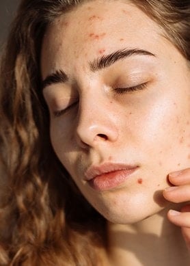 Eine junge Frau mit braunen Locken und Aknemalen steht mit geschlossenen Augen in der Sonne