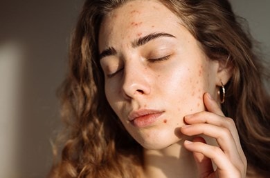 Eine junge Frau mit braunen Locken und Aknemalen steht mit geschlossenen Augen in der Sonne
