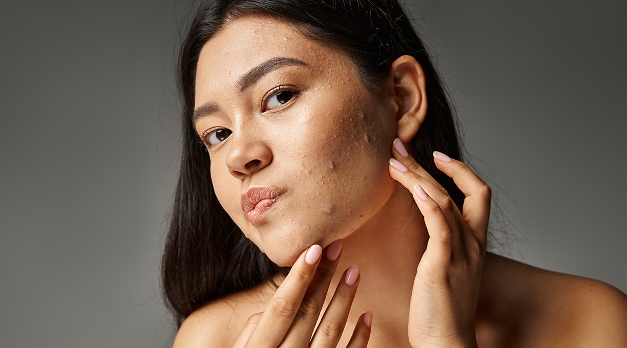 Junge Frau mit kritischem Blick und Akne auf der Wange