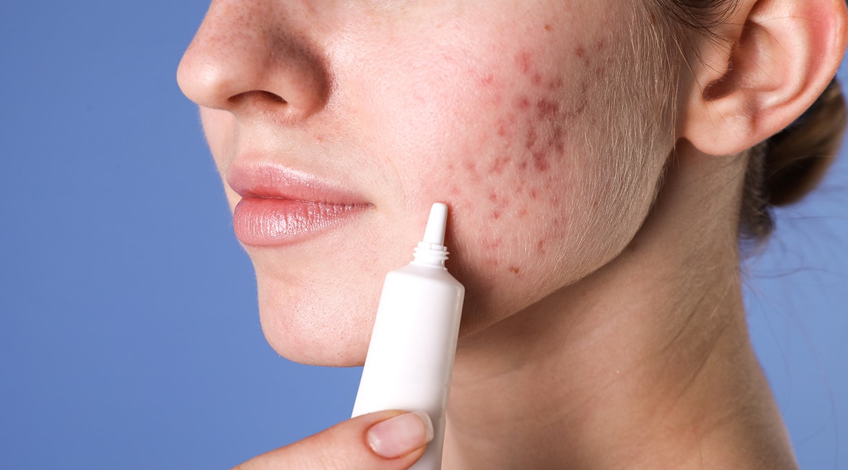 Wangenpartie einer Frau mit zystischer Akne, die eine Tube Hautpflege an ihr Gesicht hält