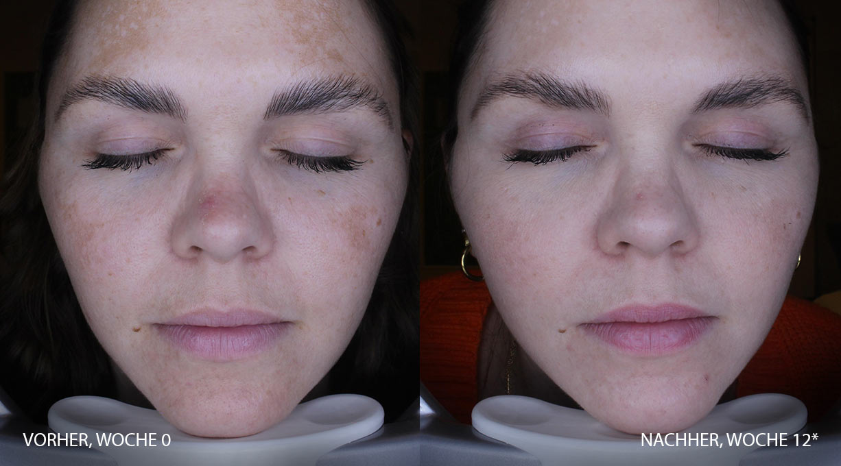 Nahaufnahmen des Gesichts vor und nach zwölfwöchiger Behandlung mit sichtbarer Verbesserung der Pigmentflecken.