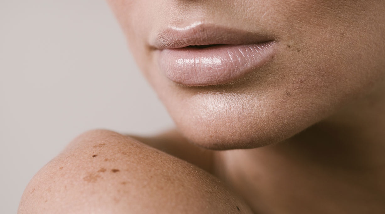 Mundpartie und Schulter einer Frau mit braunen Flecken auf der Haut