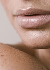 Mundpartie und Schulter einer Frau mit braunen Flecken auf der Haut