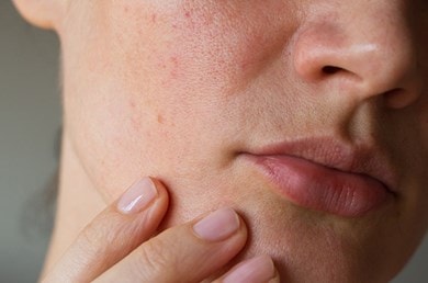 Lippen- und Kieferpartie einer Person mit geröteter Haut