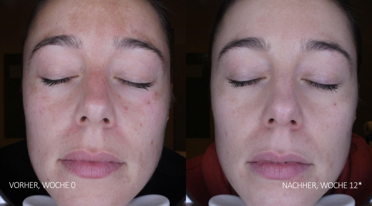 Vergleichsfotos zeigen Verbesserung von Pigmentflecken im Gesicht vor und nach zwölf Wochen