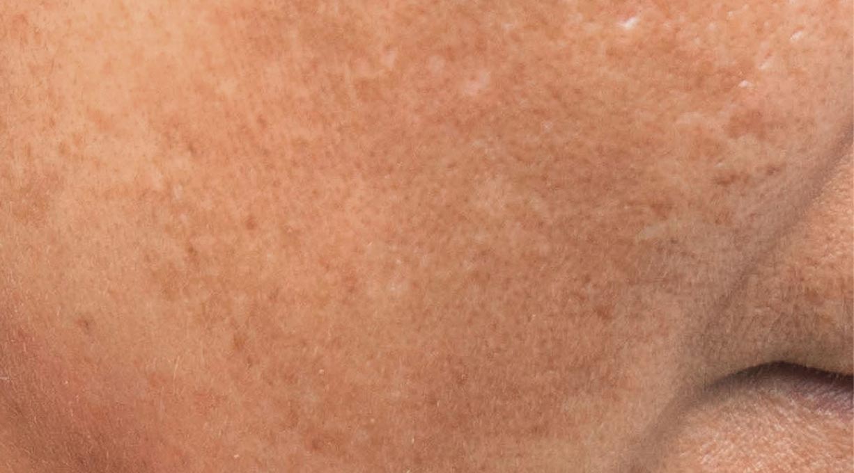 Wangenpartie mit sichtbaren Pigmentflecken und leicht unebenem Hautton