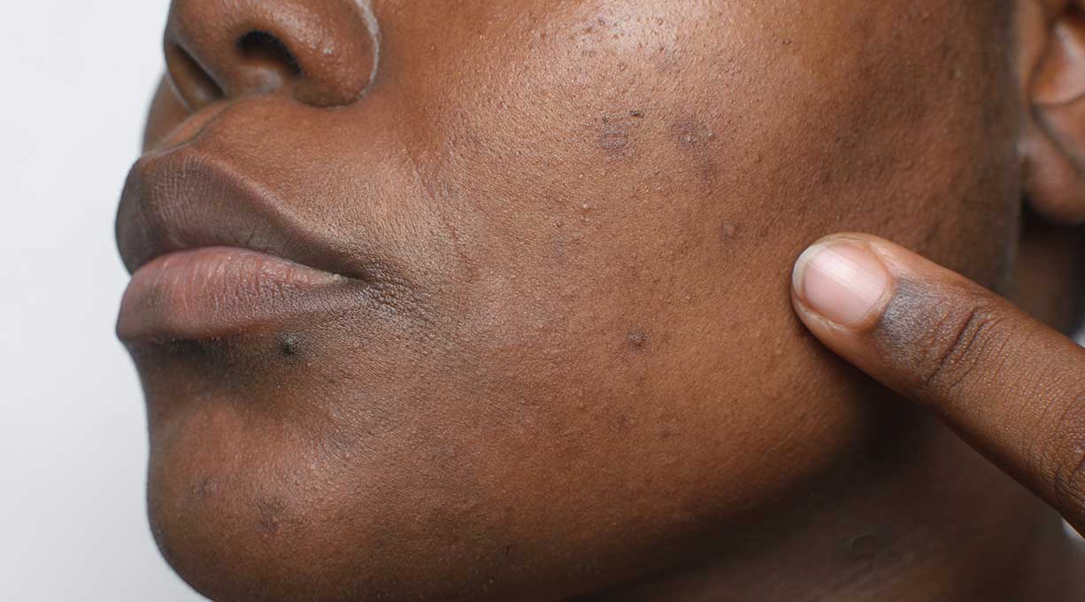 Nahaufnahme dunkler Haut mit Pigmentstörungen, Finger deutet auf Pigmentflecken