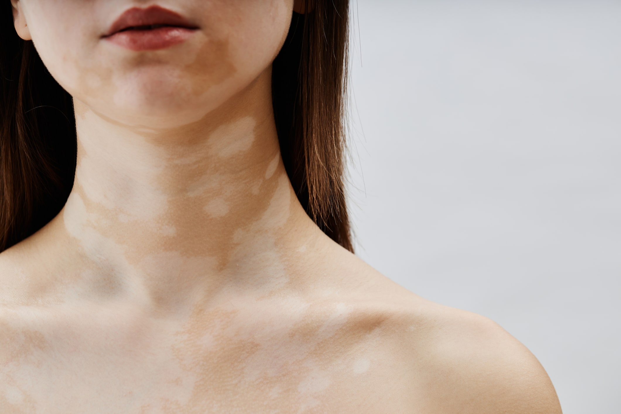 Vitiligo sichtbar als helle Flecken auf Hals und Dekolleté einer Frau