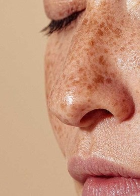Frau trägt Gesichtscreme auf, Pflege für feuchtigkeitsarme Haut mit Sommersprossen