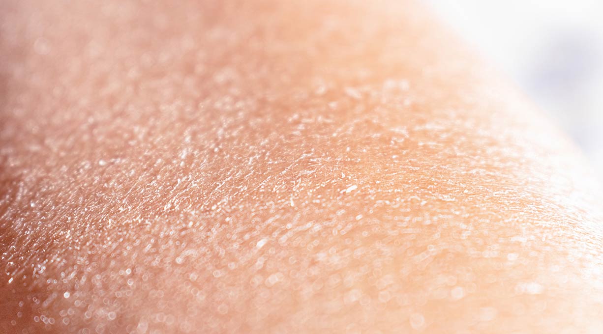 Detailaufnahme trockener Haut mit feinen Schuppen und rauer Struktur