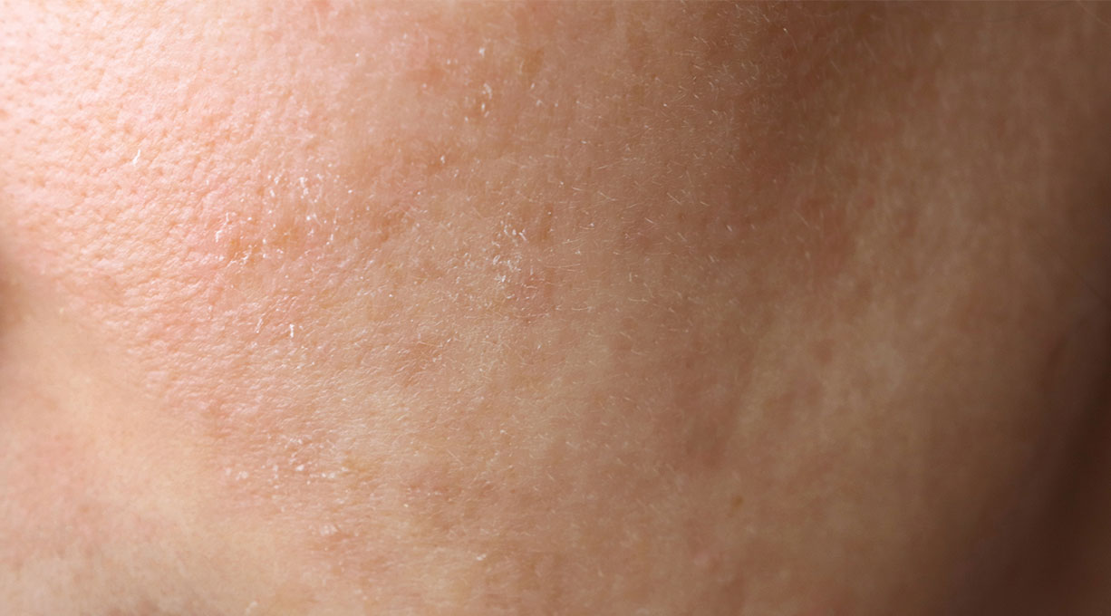 Nahaufnahme von Haut mit Feuchtigkeitsmangel und feinen Trockenheitslinien