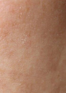 Nahaufnahme von Haut mit Feuchtigkeitsmangel und feinen Trockenheitslinien