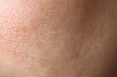 Nahaufnahme von Haut mit Feuchtigkeitsmangel und feinen Trockenheitslinien