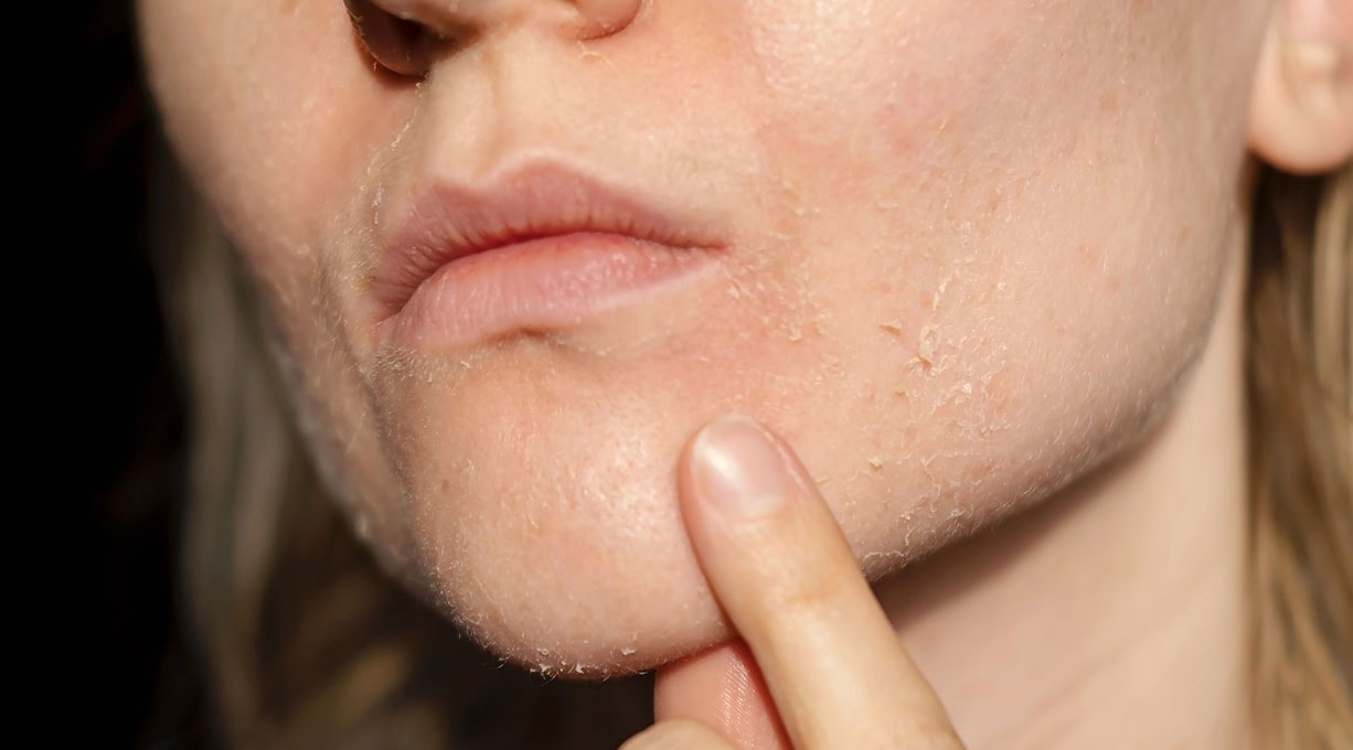 Kieferpartie einer Frau mit trockener, schuppiger Haut