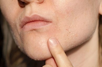 Kieferpartie einer Frau mit trockener, schuppiger Haut