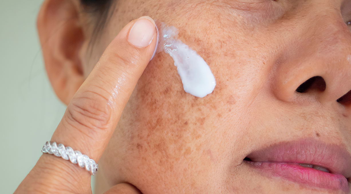 Frau mit Altersflecken im Gesicht trägt eine weiße Creme mit Finger auf