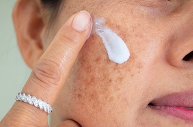 Frau mit Altersflecken im Gesicht trägt eine weiße Creme mit Finger auf