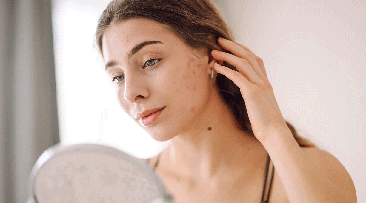 Frau mit Akne betrachtet sich im Kosmetikspiegel