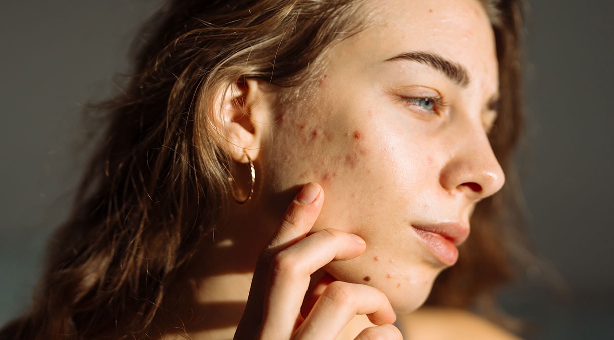 Eine junge Frau mit Akne von der Seite