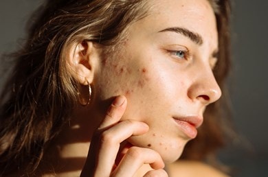 Eine junge Frau mit Akne von der Seite