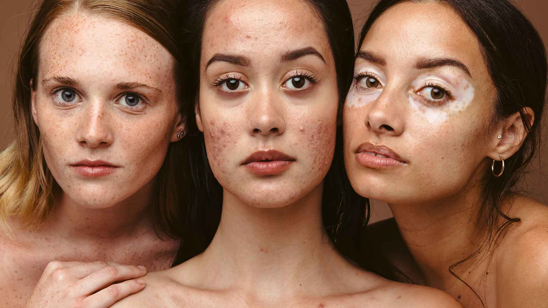 Drei junge Frauen mit Mischhaut und Akne