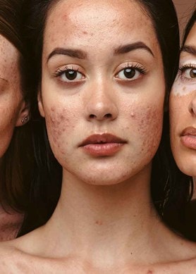 Drei junge Frauen mit Mischhaut und Akne