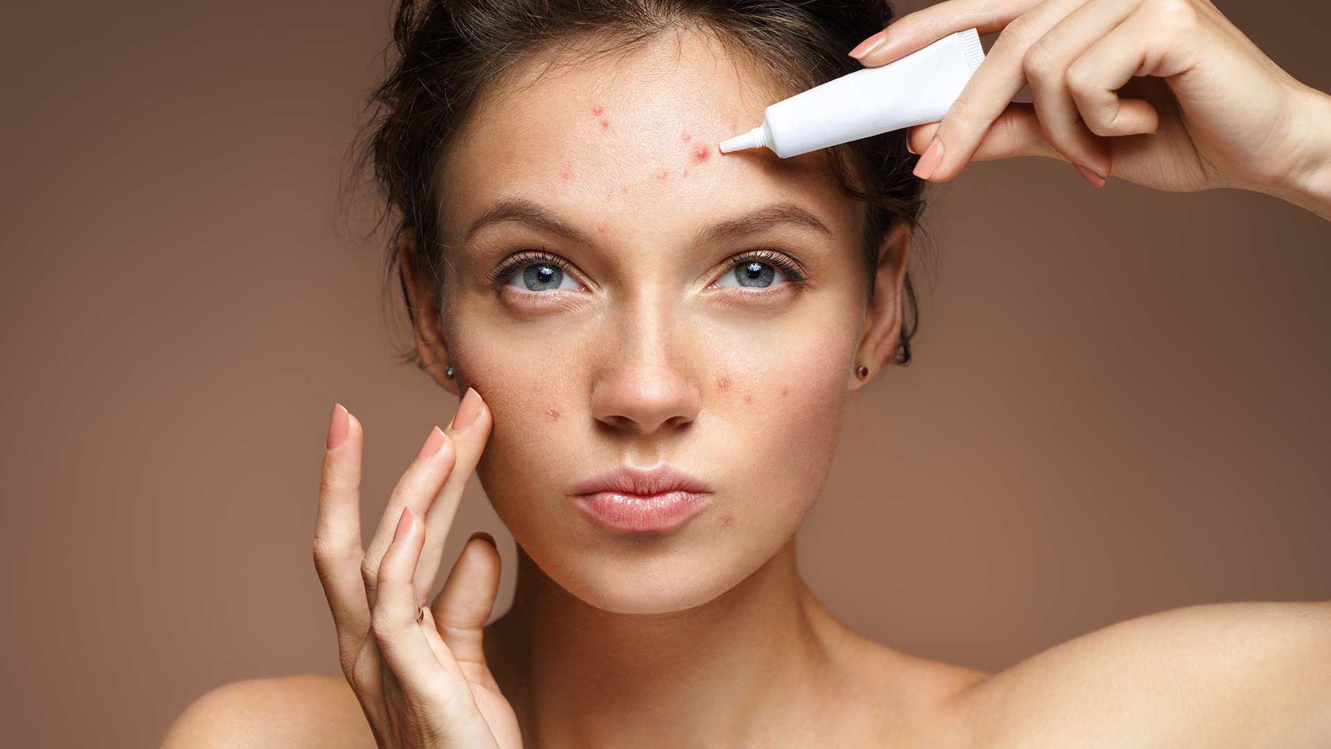 Eine junge Frau mit Akne trägt Make-Up im Gesicht auf um ihre Unreinheiten zu verdecken