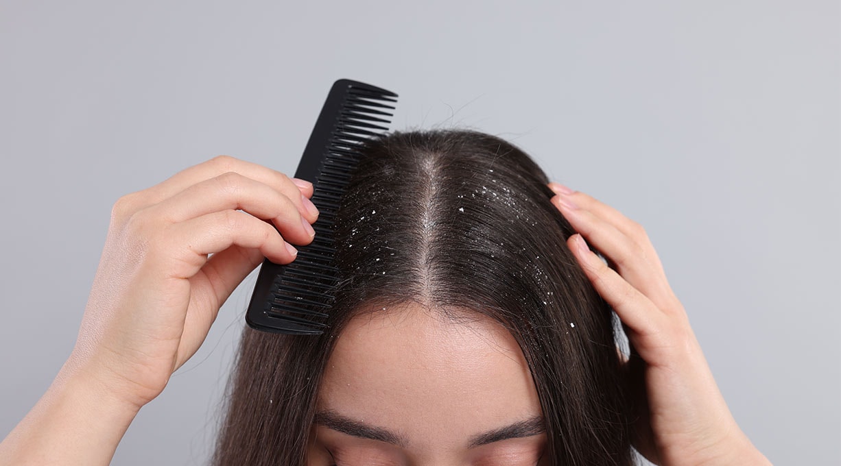 Eine Hand kämmt dunkles Haar mit einem schwarzen Kamm, sichtbare Schuppen verteilen sich auf der Kopfhaut und dem Haarscheitel.