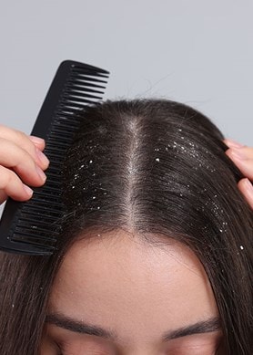 Eine Hand kämmt dunkles Haar mit einem schwarzen Kamm, sichtbare Schuppen verteilen sich auf der Kopfhaut und dem Haarscheitel.