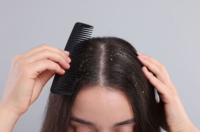 Eine Hand kämmt dunkles Haar mit einem schwarzen Kamm, sichtbare Schuppen verteilen sich auf der Kopfhaut und dem Haarscheitel.