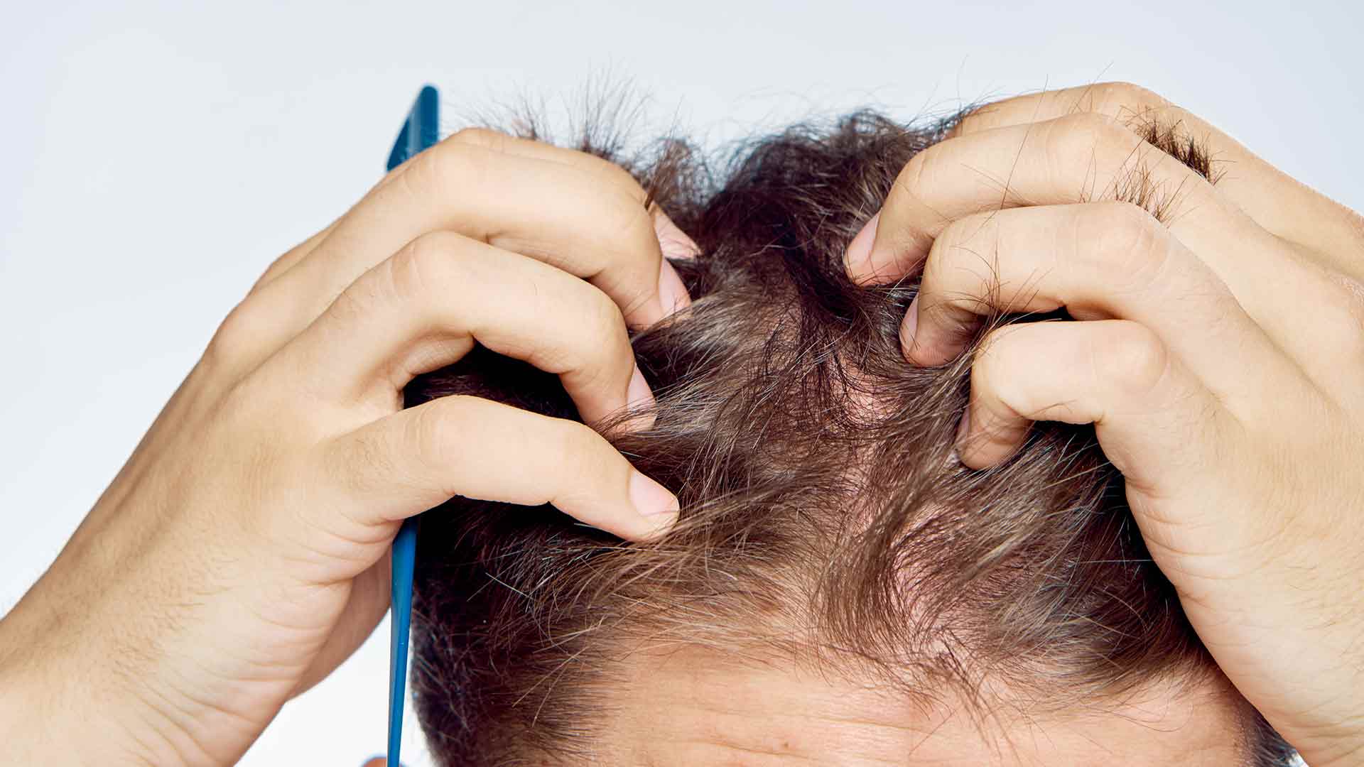 Nahaufnahme von Händen, die die Kopfhaut eines Mannes mit braunen Haaren untersuchen, während ein blauer Kamm in der linken Hand sichtbar ist.
