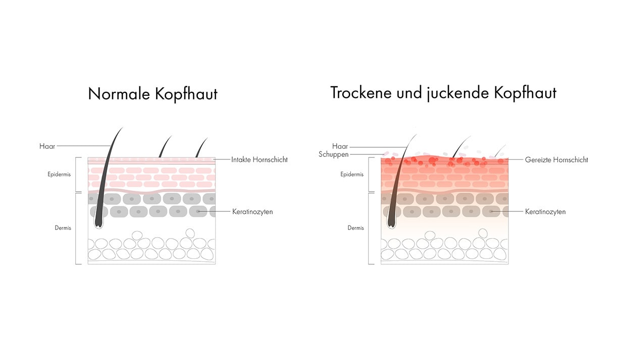 Infografik mit einer schematischen Abbildung der Hautschichten bei normaler Kopfhaut und einer Abbildung bei trockener, juckender Kopfhaut