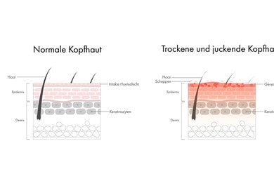 Infografik mit einer schematischen Abbildung der Hautschichten bei normaler Kopfhaut und einer Abbildung bei trockener, juckender Kopfhaut