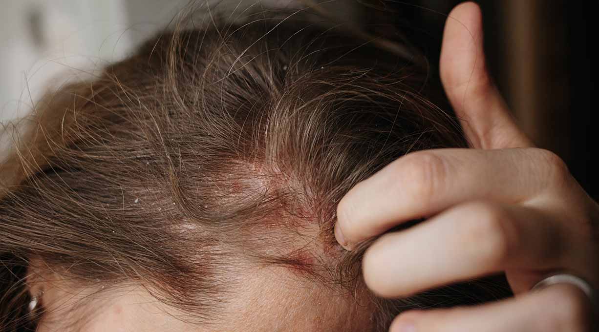 Frau kratzt an einem geröteten, schuppigen Bereich ihrer juckenden Kopfhaut