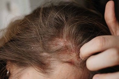 Frau kratzt an einem geröteten, schuppigen Bereich ihrer juckenden Kopfhaut