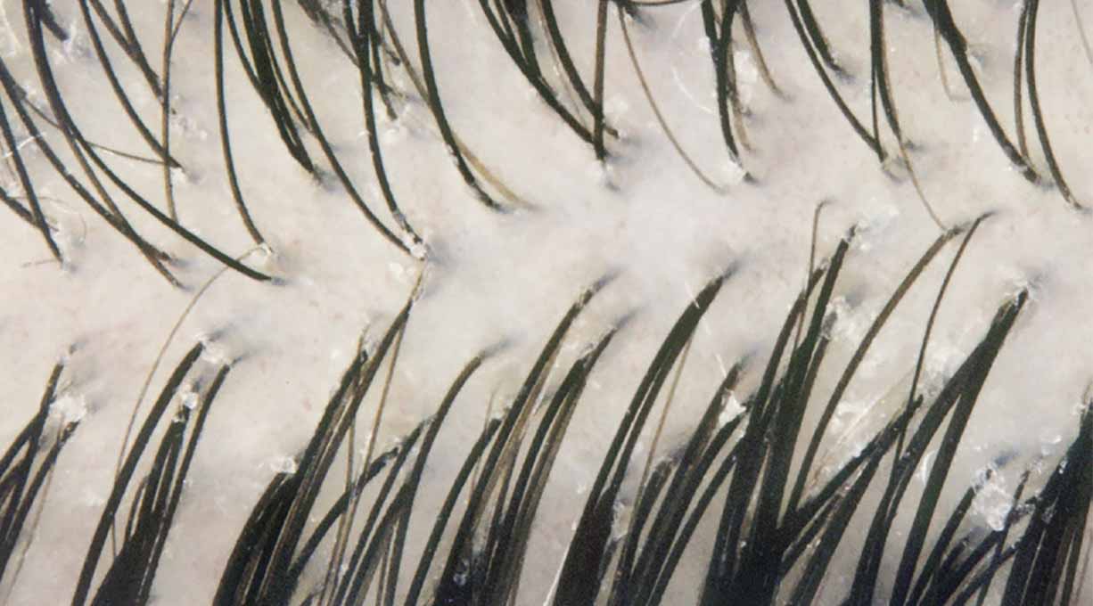 Nahaufnahme von dunklen, feinen Haaren, die aus einer hellen, schuppigen Hautoberfläche wachsen. Die Haut wirkt trocken und irritiert.