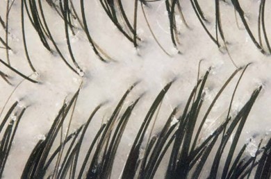 Nahaufnahme von dunklen, feinen Haaren, die aus einer hellen, schuppigen Hautoberfläche wachsen. Die Haut wirkt trocken und irritiert.