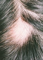 Nahaufnahme einer Kopfhaut mit kreisrundem Haarausfall am Scheitel