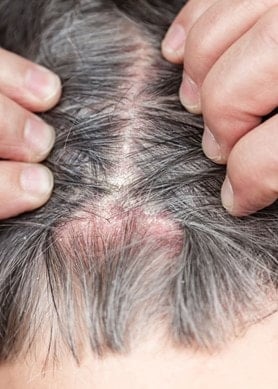 Person von hinten, die ihre Kopfhaut mit Psoriasis offenlegt