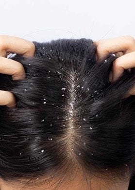 Kopf einer Person von oben mit dunklen Haaren und grossen Schuppen