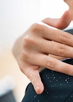 Eine Person streicht mit ihrer Hand trockene Schuppen von ihrer Schulter