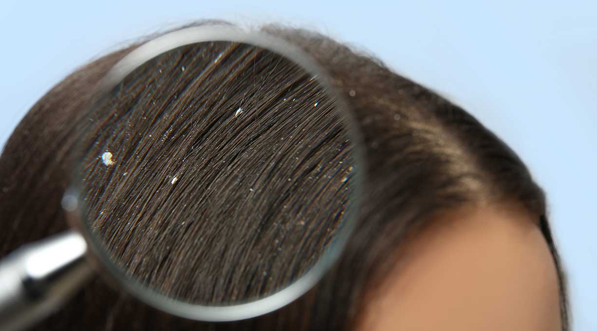 Haaransatz einer dunkelhaarigen Person mit weißen Schuppen durch eine Lupe