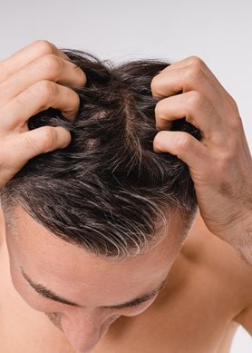 Mann mit dunklen Haaren von oben, der mit den Fingerspitzen seine Kopfhaut kratzt