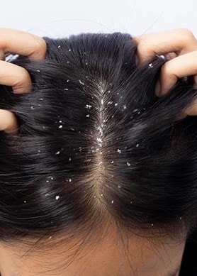 Frau mit dunklen Haaren und Schuppen am Haaransatz und sich dabei in die Haare greift