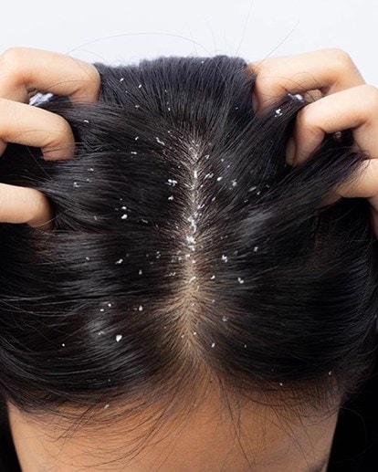 Frau mit dunklen Haaren und Schuppen am Haaransatz und sich dabei in die Haare greift
