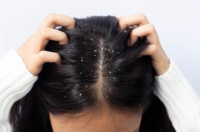 Frau mit dunklen Haaren und Schuppen am Haaransatz und sich dabei in die Haare greift
