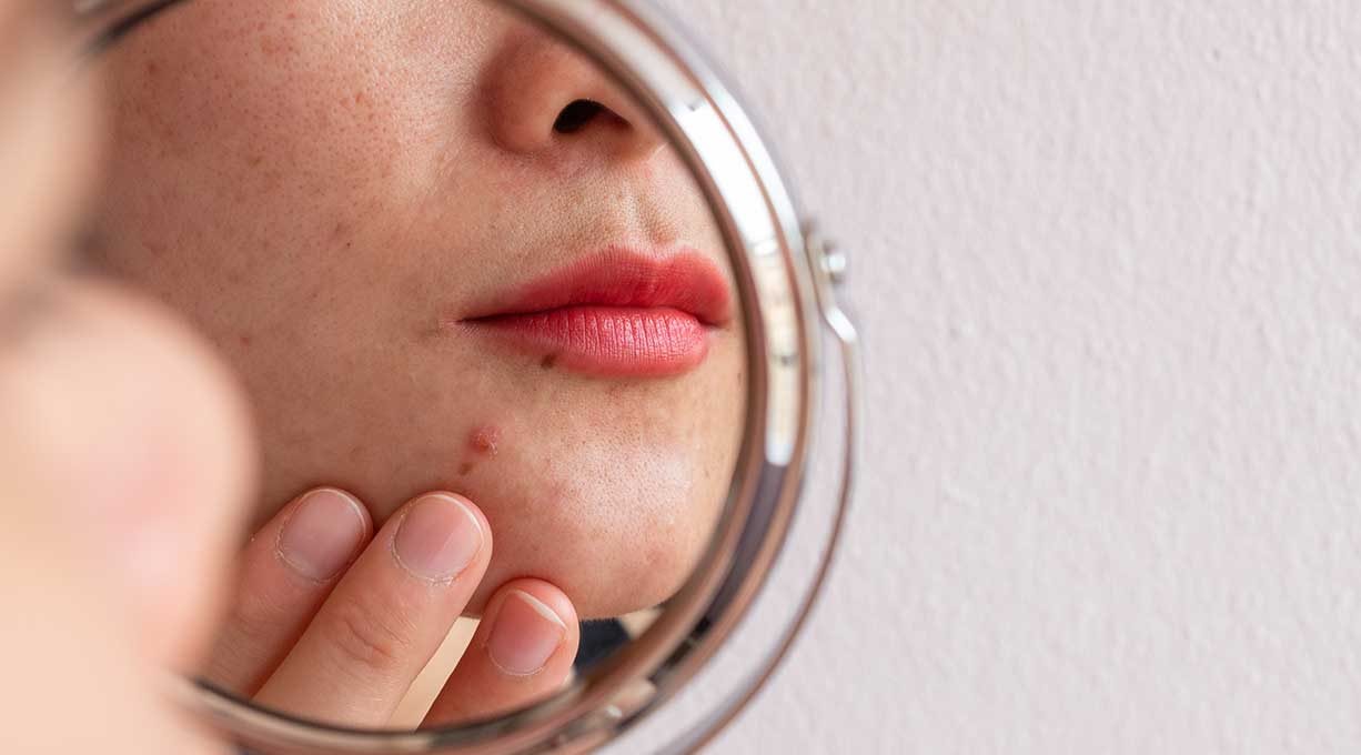 Mund, Kinn und Wange einer Frau im Spiegel mit unreiner Haut und rot geschminkten Lippen